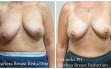 scarless_breast_reduction_before_afer_15