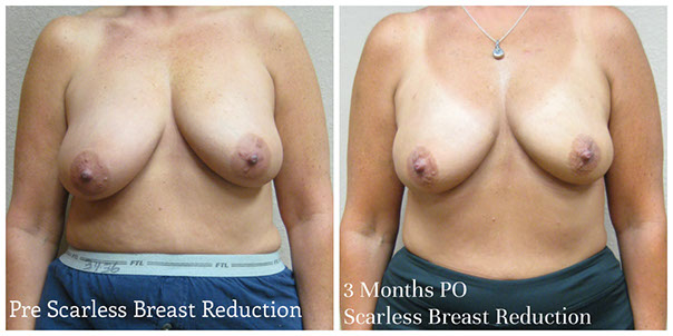 scarless_breast_reduction_before_afer_15