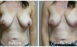 scarless_breast_reduction_before_after_1