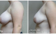 scarless_breast_reduction_before_after_10