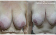 scarless_breast_reduction_before_after_11