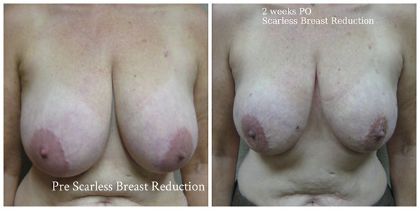 scarless_breast_reduction_before_after_11