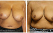 scarless_breast_reduction_before_after_13