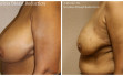 scarless_breast_reduction_before_after_14