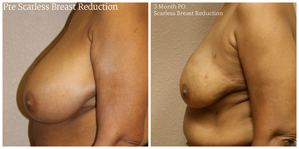 scarless_breast_reduction_before_after_14