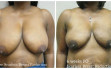 scarless_breast_reduction_before_after_17