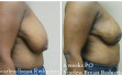 scarless_breast_reduction_before_after_18