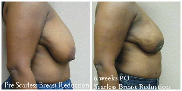 scarless_breast_reduction_before_after_18