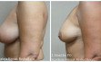 scarless_breast_reduction_before_after_19