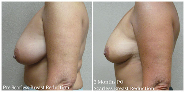 scarless_breast_reduction_before_after_19