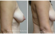 scarless_breast_reduction_before_after_2