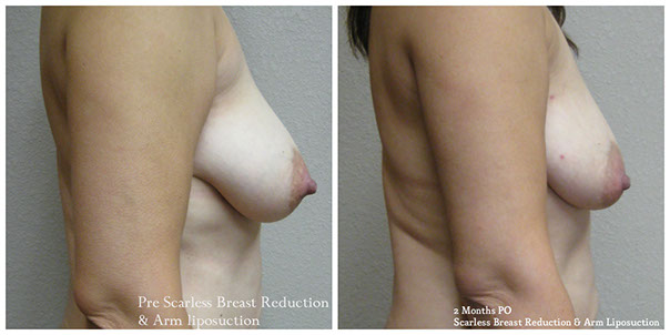 scarless_breast_reduction_before_after_2