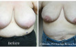 scarless_breast_reduction_before_after_3