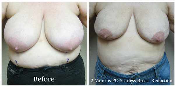 scarless_breast_reduction_before_after_3
