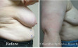 scarless_breast_reduction_before_after_3_1