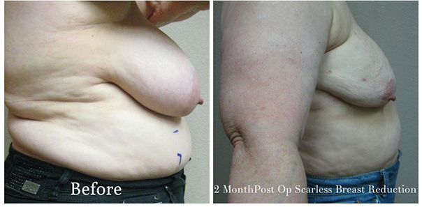 scarless_breast_reduction_before_after_3_1