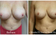 scarless_breast_reduction_before_after_4