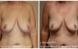 scarless_breast_reduction_before_after_5
