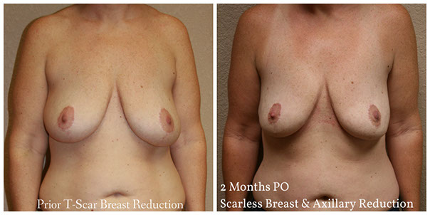 scarless_breast_reduction_before_after_5