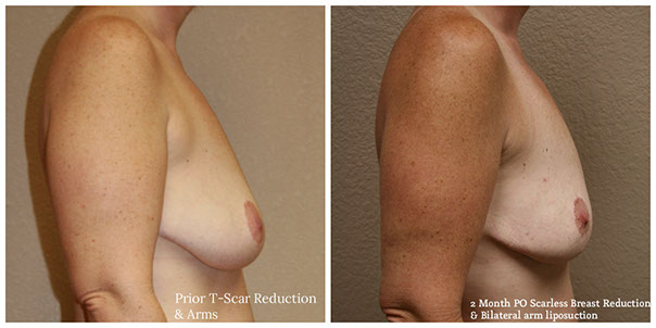 scarless_breast_reduction_before_after_6
