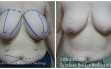 scarless_breast_reduction_before_after_7