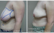 scarless_breast_reduction_before_after_8