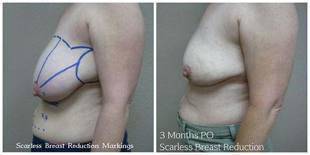 scarless_breast_reduction_before_after_8