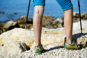 Lasers Vs. Radiofrequency for Varicose Veins
